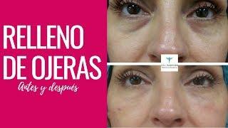 Rellenos Faciales Para Ojeras en Mujeres de 40 años y más | Cuarentonas y Felices