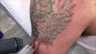 Does Laser Tattoo Removal Hurt, Skin Deep Laser Services, Fairfax VA, Arlington VA, Alexandria VA