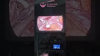 In this case, Dr. Sushmita performs a total laparoscopic hysterectomy and removes.