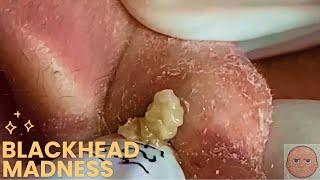 Relaxing Blackheads removal #47