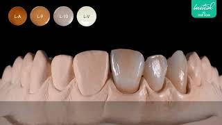 Characterization of your anterior bridge with Initial IQ ONE SQIN in a two step technique