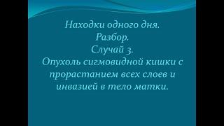 Находки одного дня. Случай 3. Опухоль сигмовидной кишки с инвазией в тело матки.