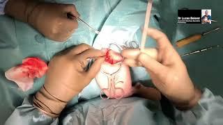 FHO Femoral Head Ostectomy