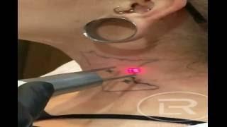 MN Outline Neck Session Two Laser Tattoo Removal by Renewal Laser