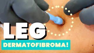 LEG DERMATOFIBROMA!