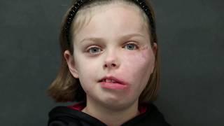 Before Facial Palsy | Pediatric Facial Paralysis | Dr. Teresa O New York Facial Paralysis