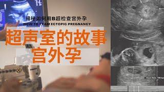 深度解析宫外孕：宫外孕是怎么形成的，常见症状和类型，危险因素，什么人容易得，B超如何检查，治疗和预防【Ultrasound Room】How to exam ectopic pregnancy