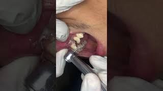 Removing cavity for composite filling #umairtoothfairy #dentist #smile #umairazeem @Umairazeem8553