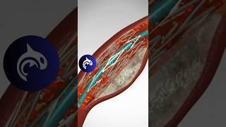 See how an Angioplasty and Stent Placement work in 3D animation