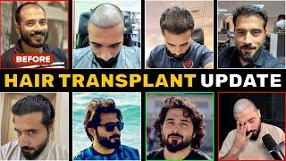 My Hair Transplant After 3 Years Update | Turkey vs Pakistan | Before and After Photos