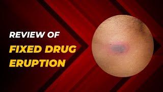 A review of fixed drug eruption