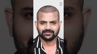 Youtuber Topa Bhai ( Nadeem Bunny ) Hair Transplant Progress #shorts#hairtransplant