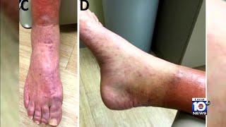 Leprosy cases on the rise in Florida