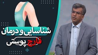 شناسایی و درمان قارچ پوستی در گفتگو با متخصص پوست و مو