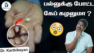 Will Crown Falls Out? - ஏன் கேப் (Cap) அடிக்கடி கழண்டு வருகிறது? | Denta Kings