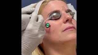 Pulsed Dye Laser Application with Dermatologist Dr. Emmy Graber