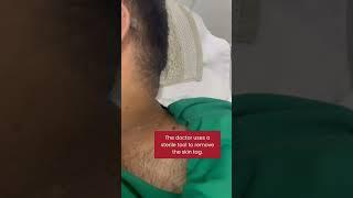 Skin Tags Removal Treatment by Dr Neha Sodhi