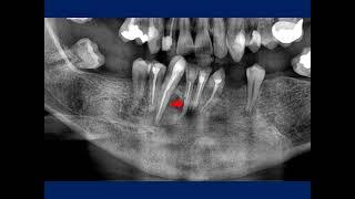 Management of root resorption