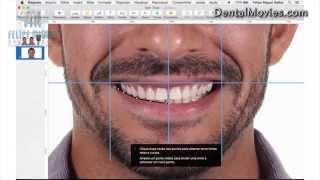 DSD - Digital Smile Design by Felipe Miguel