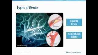 Kaiser Permanente Santa Clara Stroke Presentation