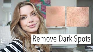 Remove Dark Spots!! | Esthetician Tips For Skin Discoloration | Bauer Beauty