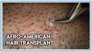 Afro-American Hair Transplant Follicular Unit Extraction [Maximum Zoom!]