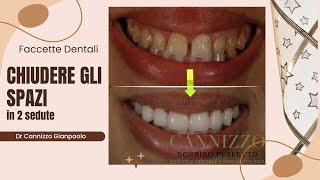 Estetica dentale con faccette in ceramica - Studio Cannizzo