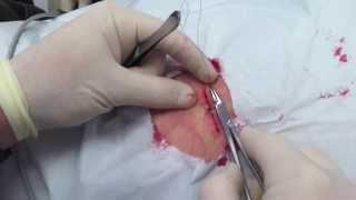 Melanoma Excision