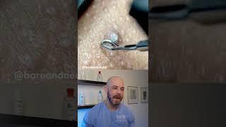 Gnarly ingrown hair removal! #dermreacts #doctorreacts #ingrownhair