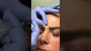 Seriously Skin Botox Treatment for Angry Lines Glabellar Lines