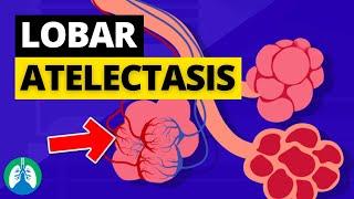 Lobar Atelectasis (Medical Definition) | Quick Explainer Video