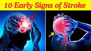 10 Warning Signs of Stroke One Month Before It Happens