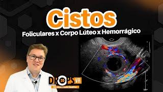 CISTOS OVARIANOS: FUNCIONAIS, FOLICULARES, DE CORPO LÚTEO E HEMORRÁGICOS NO ULTRASSOM