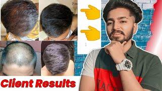 Hair Regrowth Client Results | Sahil Nagpal