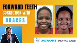 Forward Teeth Correction With Braces - by Dr.Praneeth Kumar