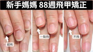 Flying nail correction success｜88 weeks of hard work｜New moms destroy a lot, second correction