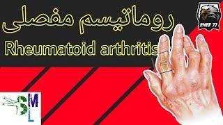 rheumatoid arthritis / روماتیسم مفصلی