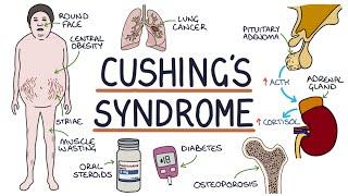 Understanding Cushing's Syndrome