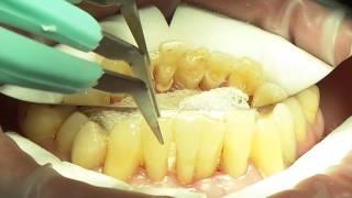 24 May. Mariia Nosova. Splinting and Periodontal Surgery. Part 1