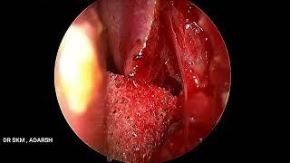 ENDOSCOPIC DCR BASIC SURGICAL STEPS