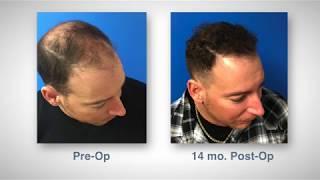 Follicular Unit Extraction (FUE Hair Transplant) Patient Testimonial