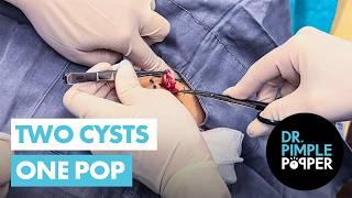 Two Cysts One Pop