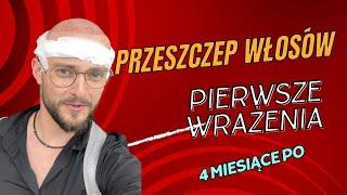 Mój Przeszczep Włosów- jak to wszystko przebiegało?