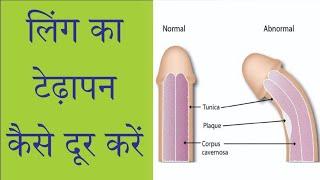 How to Fix a BENT PENIS penile curvature with herbal medicines by Dr. Nizamuddin Qasmi sir