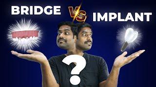 பல் கட்டுவதில் எது சிறந்த முறை ? - Dental Bridge V/s Dental Impant | Denta Kings