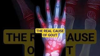 Here's Why You Have GOUT, And How To Fix It!   #gout