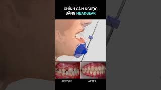 Chỉnh răng cắn ngược bằng khí cụ Facemask #braces #orthodontics