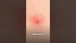 만약 갑자기 벌에 쏘인다면? #shorts