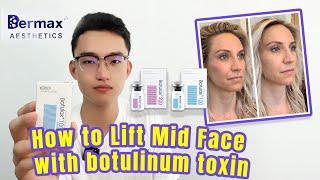 How to Lift Mid Face with botulinum toxin|Botulinum Toxin|Botulax|Meditoxin|Nabota|Innotox|Hutox