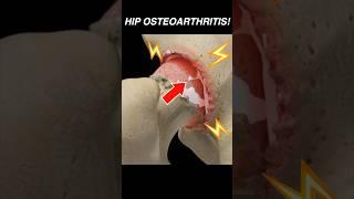 Doctor Explains: Hip OSTEOARTHRITIS 